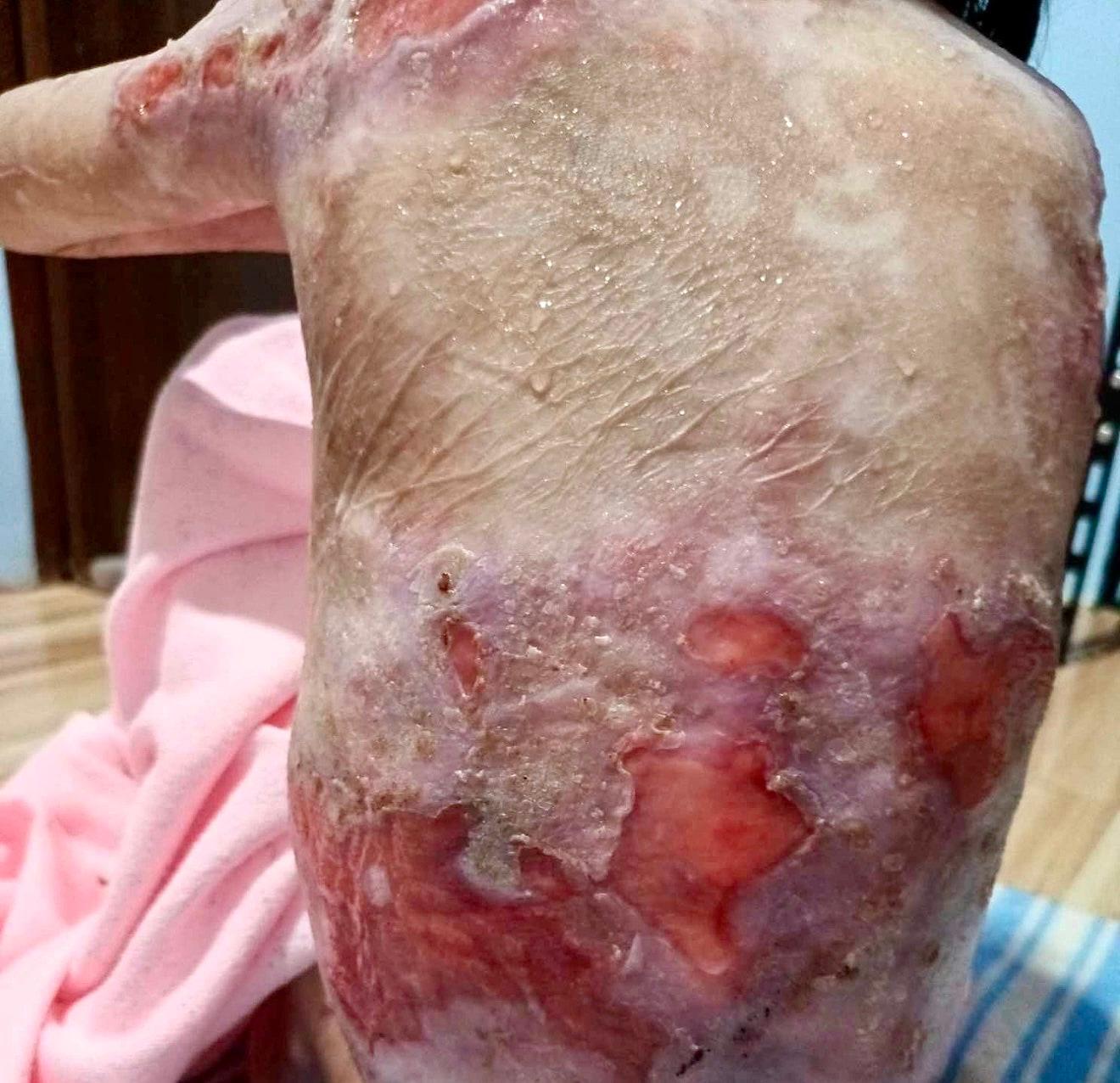 Shamila vive con un dolor que ningún niño debería soportar