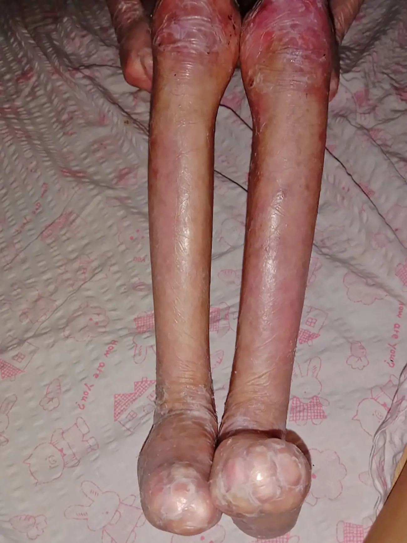 Shamila vive con un dolor que ningún niño debería soportar